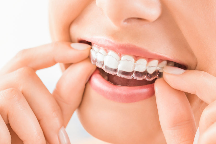 woman-placing-retainer-after-invisalign-treatment